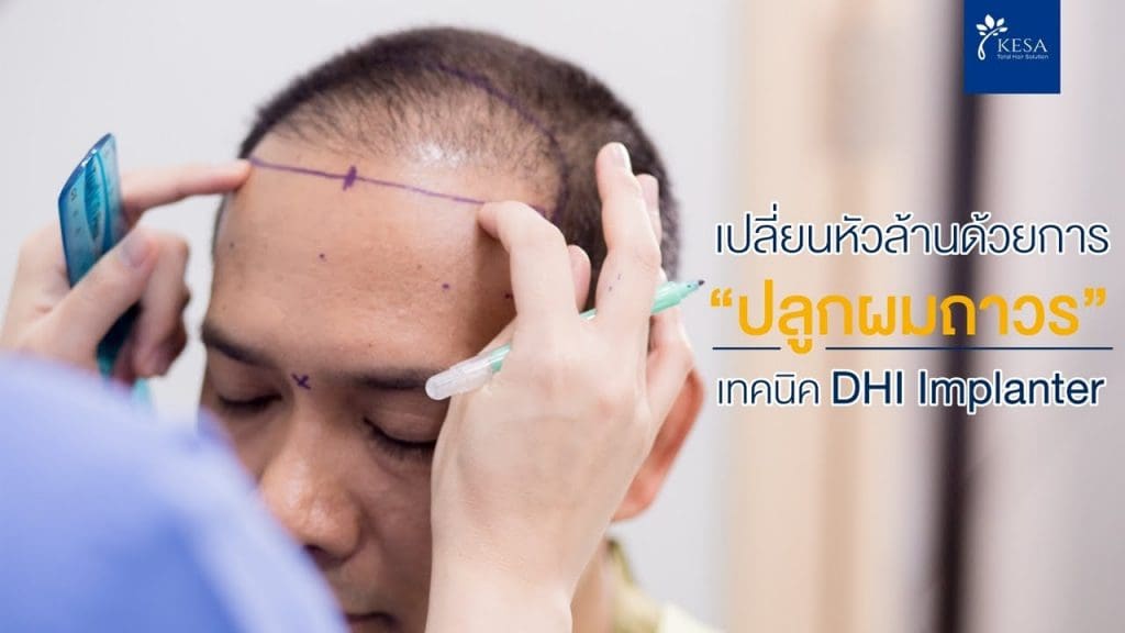 คุณธีรวีร์ ดิษยะไชยพงษ์ ( เชฟจากัวร์ )    Top Chef Thailand Season2   ปลูกผมถาวร ด้วยเทคนิค DHI Implanter 