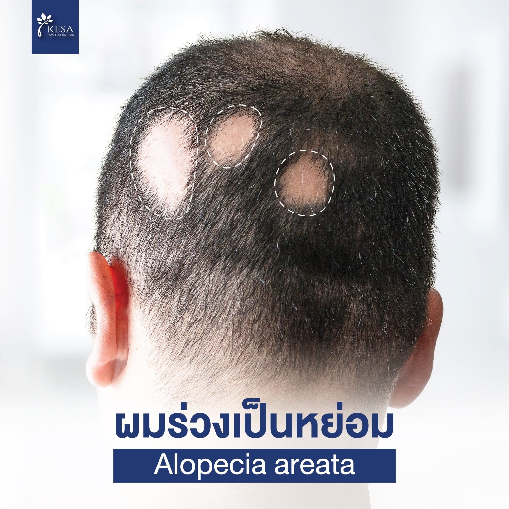โรคผมร่วงเป็นหย่อม Alopecia Areata