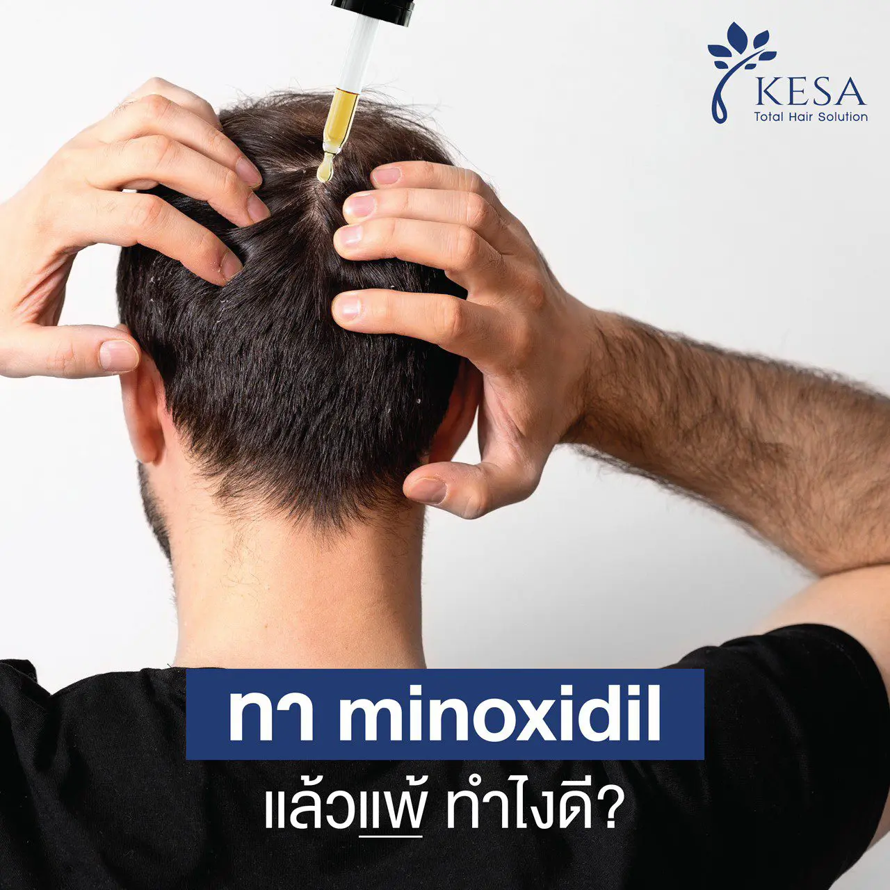 ໃຊ້ Minoxidil ແລະສູນເສຍ, ຂ້ອຍຄວນເຮັດແນວໃດ?