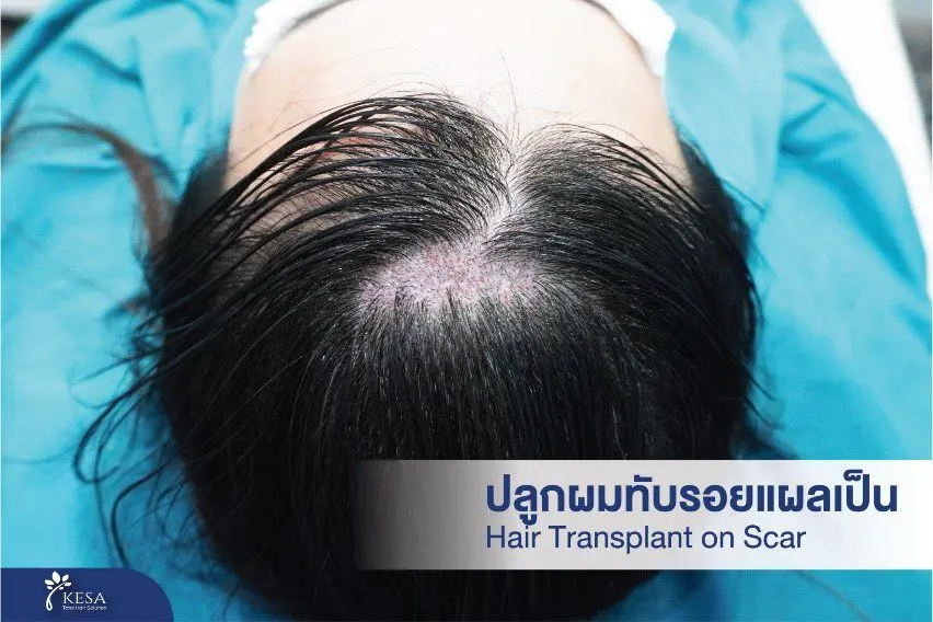 Hair transplant in scar 
