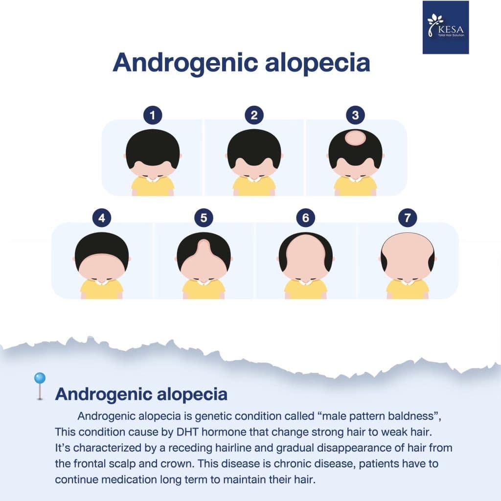  Androgenetic alopecia 7 stage