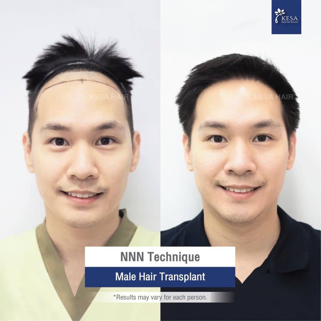 hair transplant in Androgenetic alopecia