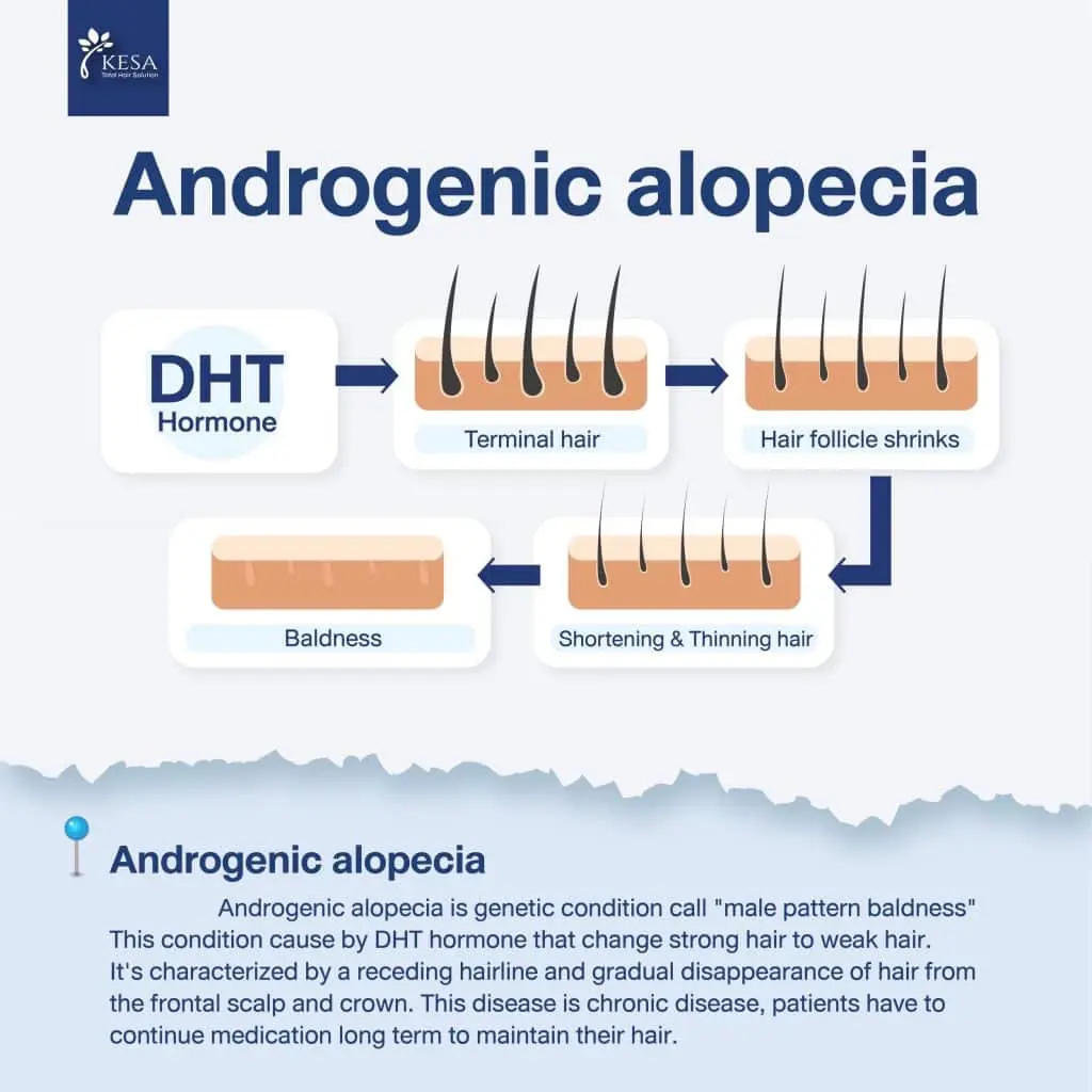  Androgenetic alopecia
