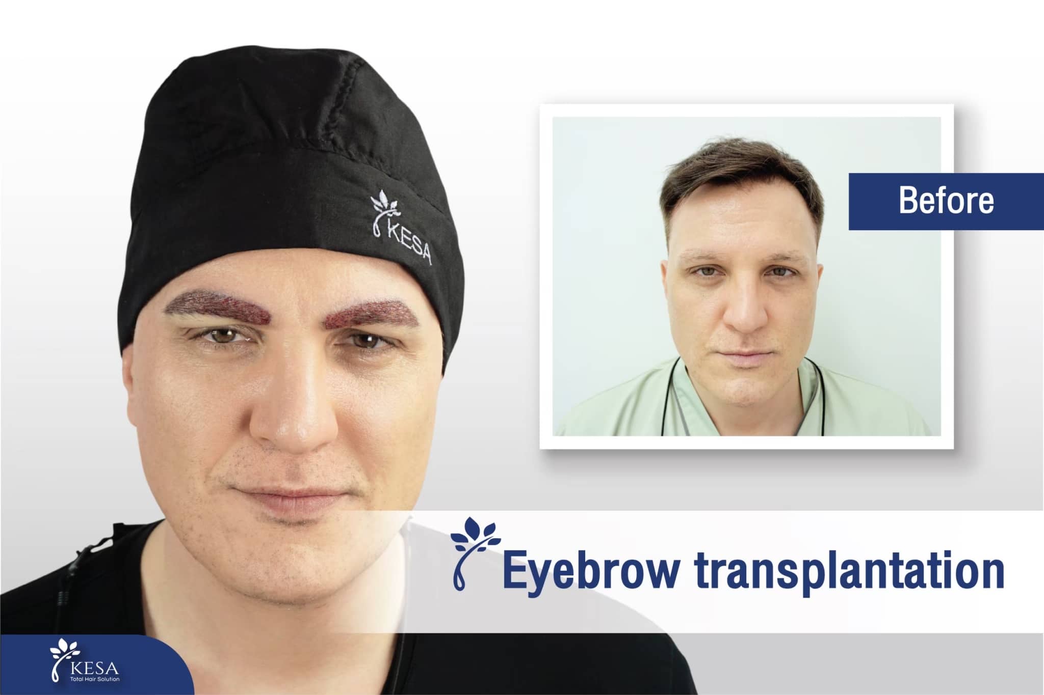 eyebrow transplant
