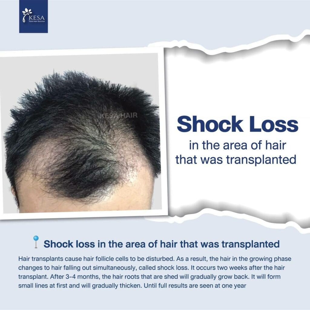 shock loss hair transplant