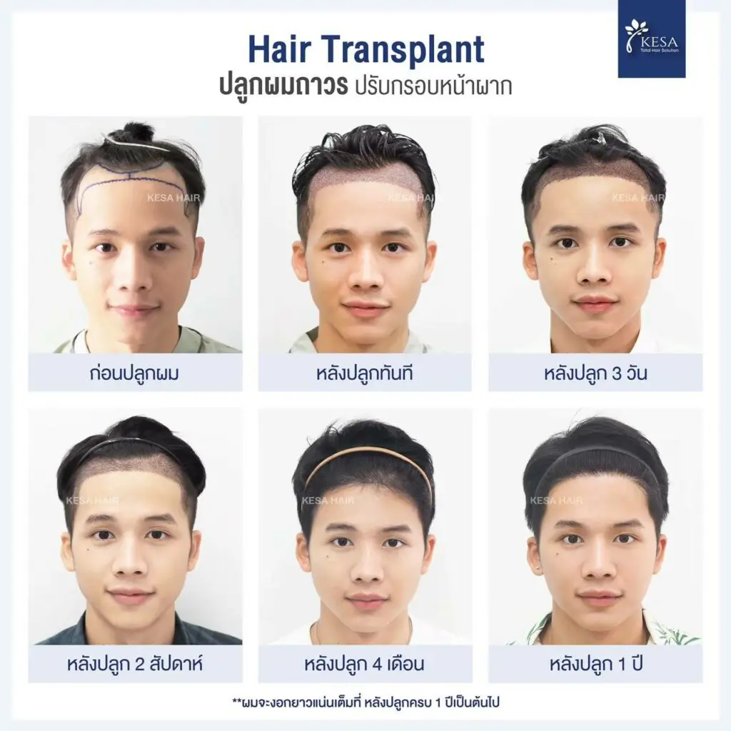 after hair transplant timeline