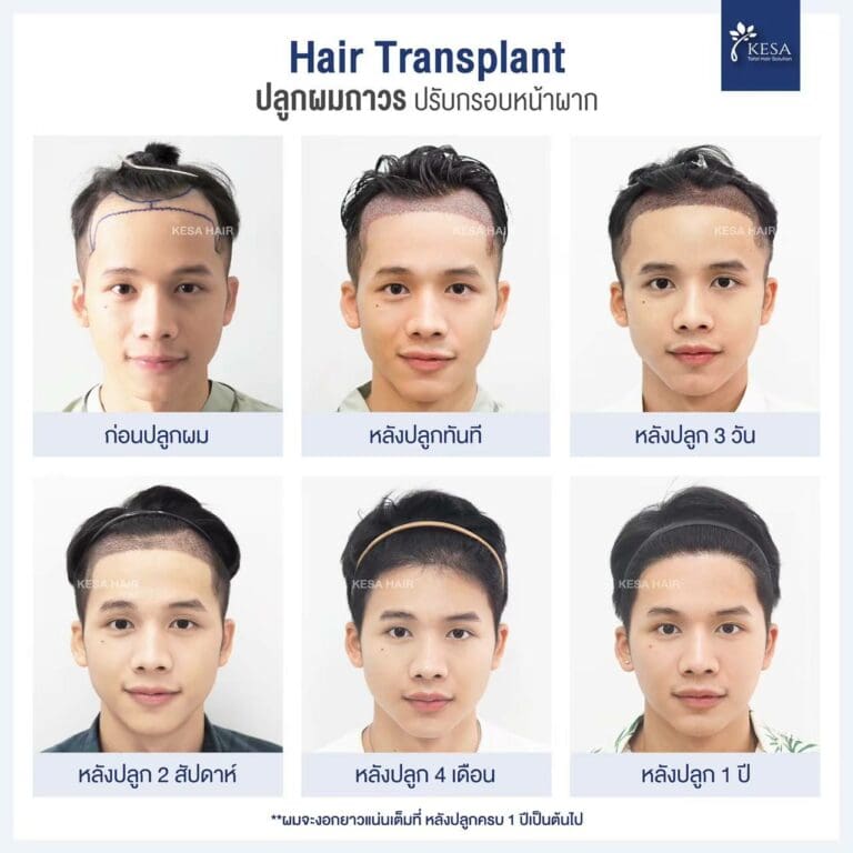 hair transplant thailand